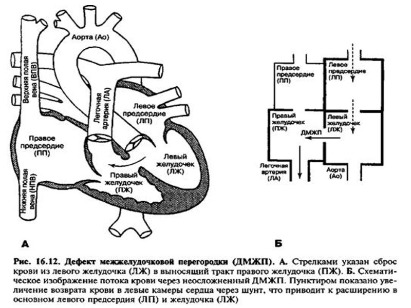 Дефект межпредсердной перегородки